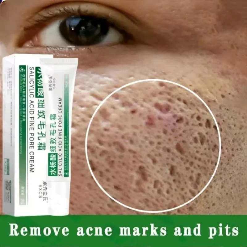 Crema limpiadora de poros de á - Salicylic Acid Blackhead Remover reseña y precio