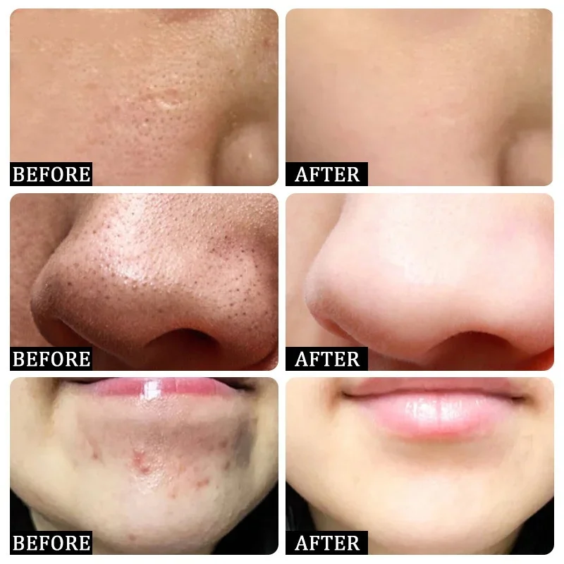 Crema limpiadora de poros de á - Salicylic Acid Blackhead Remover reseña y precio